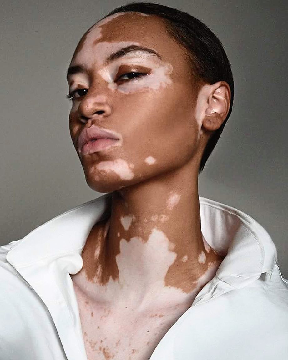 Amy Deanna, a CoverGirl márka  első vitiligós modellje, és hatalmas lépésnek tartotta a szereplését a vitiligo társadalmi elfogadásában.