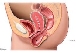 rectocele-from-fda.jpg