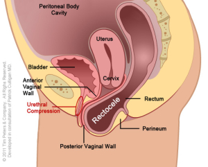 rectocele-with-uterus-image-4-300x241.jpg