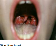 skarlátos torok.png