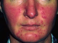 rosacea1-s