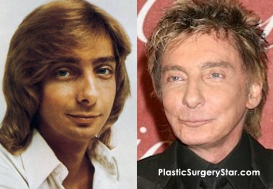 Barry-Manilow-Plastic-Surgery