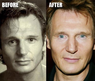 liam-neeson-plastic-surgery