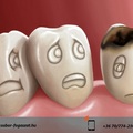 Mi is az a fogszuvasodás? A betegség tünetei, okai, kezelése.