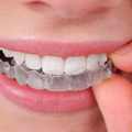 Mi okozza a fogak elszíneződését?
