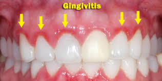 gingivitis.jpg