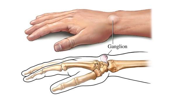 ganglion-cyst-in-wrist.jpg
