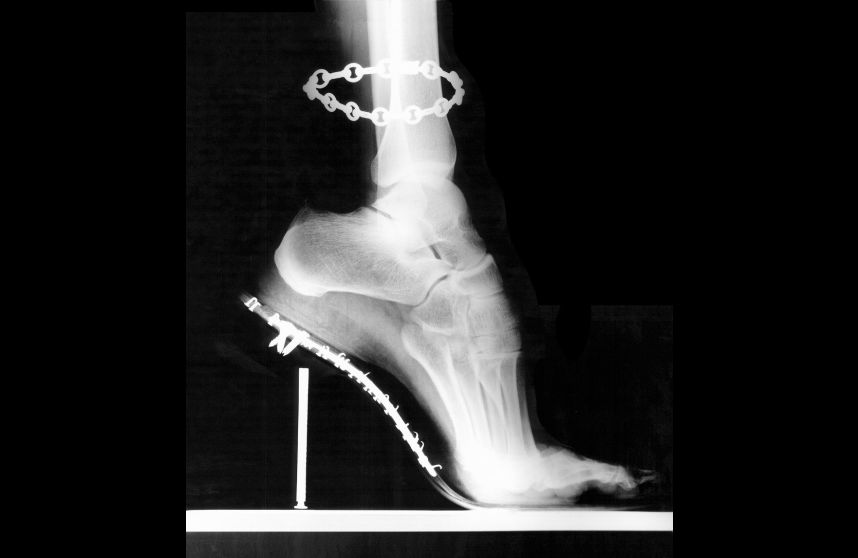 Shoe_X_Ray_1_resize2_858x558.jpg