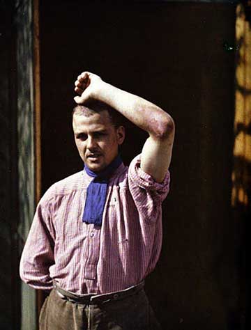 Francia katona mustárgáz okozta bőrsérülése, 1915