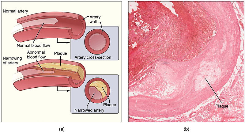 2113ab_atherosclerosis.jpg