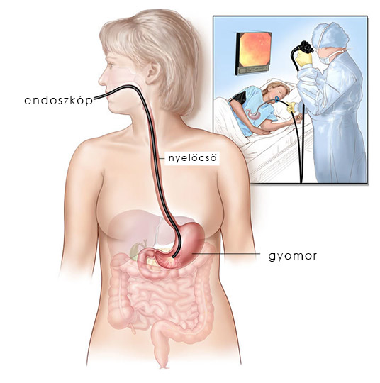 gastroenterologia-budapest-gyomortukrozes.jpg