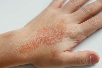 Égő érzés nyáron is?! Az ekcéma elkerülhető!