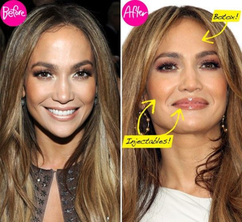 Jennifer Lopez simaságának titka: a botox