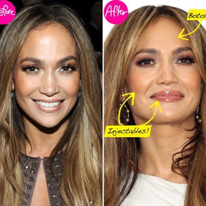 Jennifer Lopez simaságának titka: a botox
