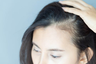 Alopecia* kezelése - kopaszság és a piócaterápia