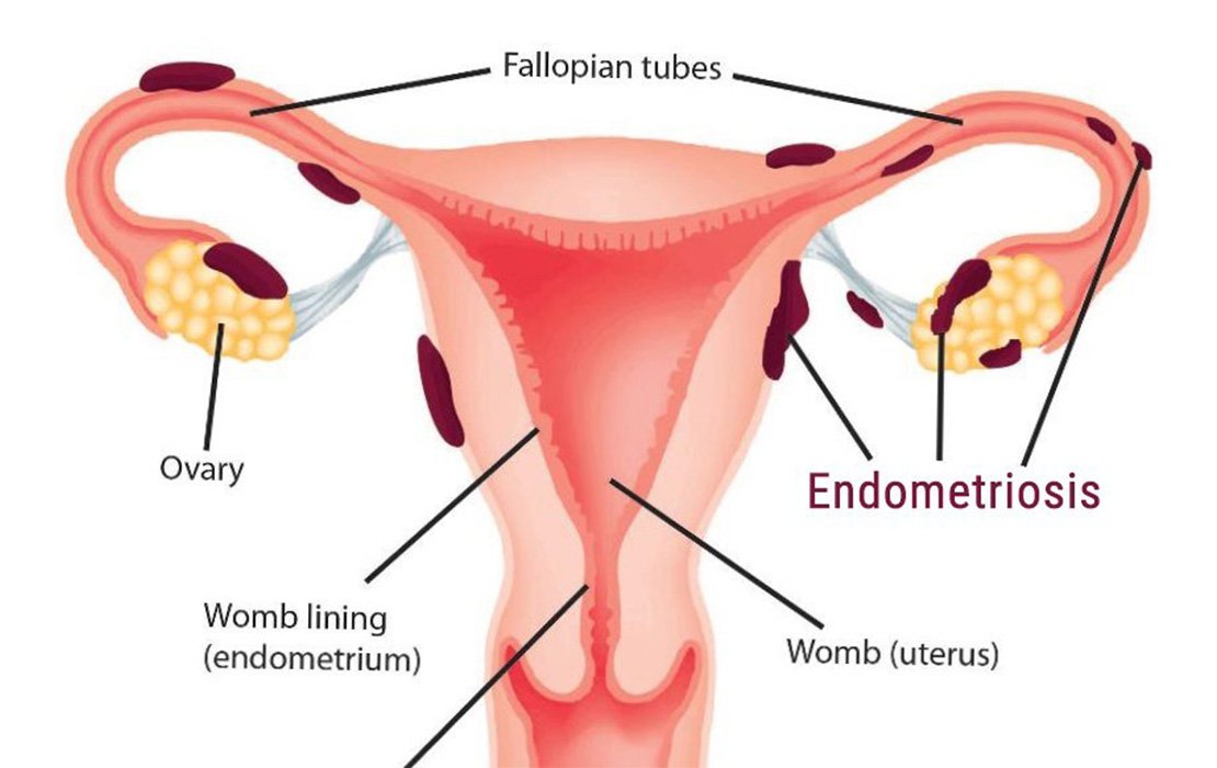 endometriosis_1110x_progressive.jpg