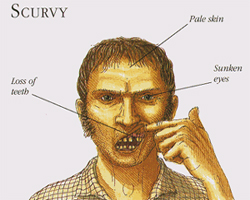 scurvy_illustration.jpg