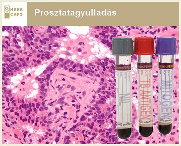 prostatitis625x500.jpg