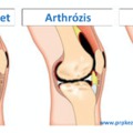 Mi a különbség? Arthralgia – Arthritis – Arthrozis