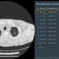 Lung CT