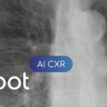 AI CXR