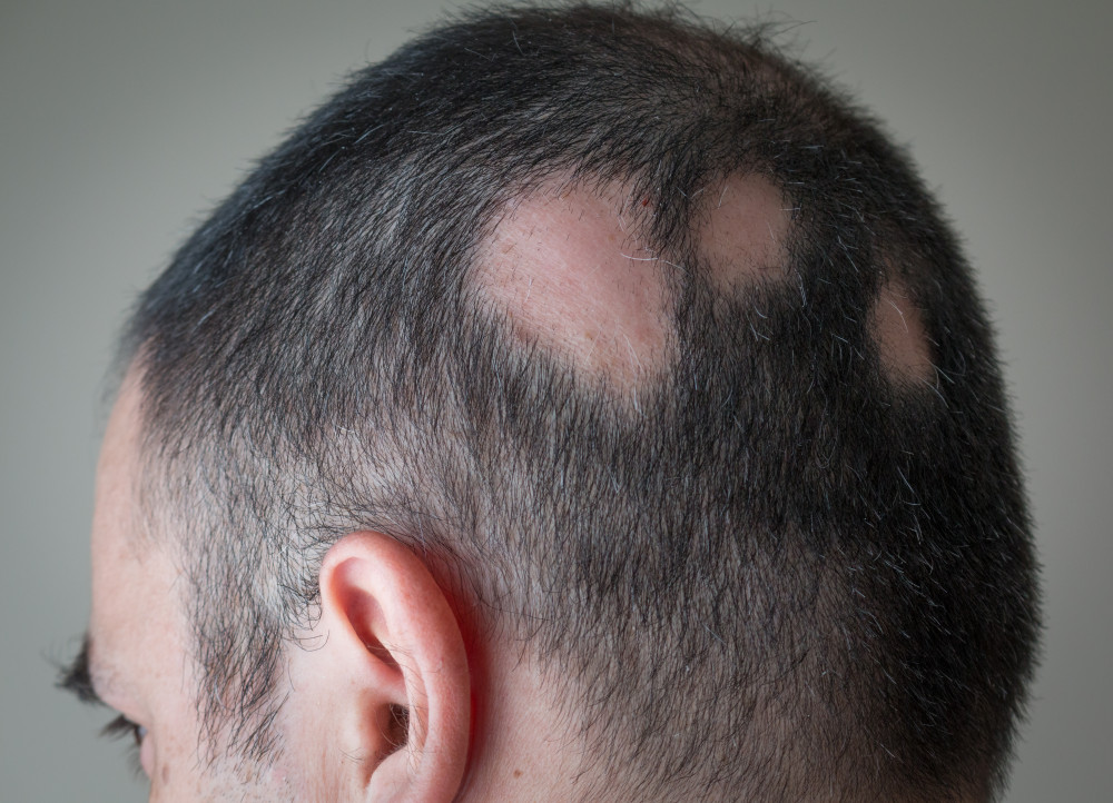 alopecia.jpg