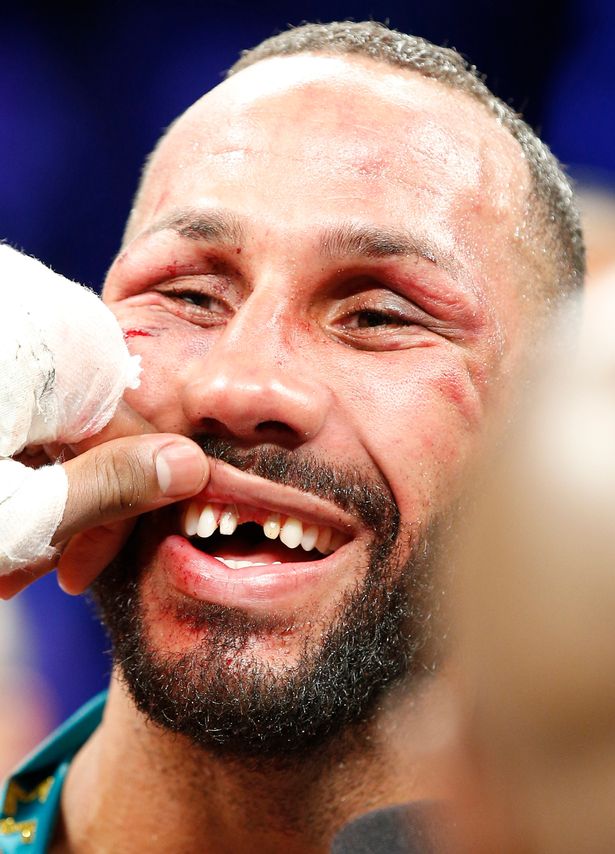 james-degale-reveals-missing-teeth-after-the-fight.jpg