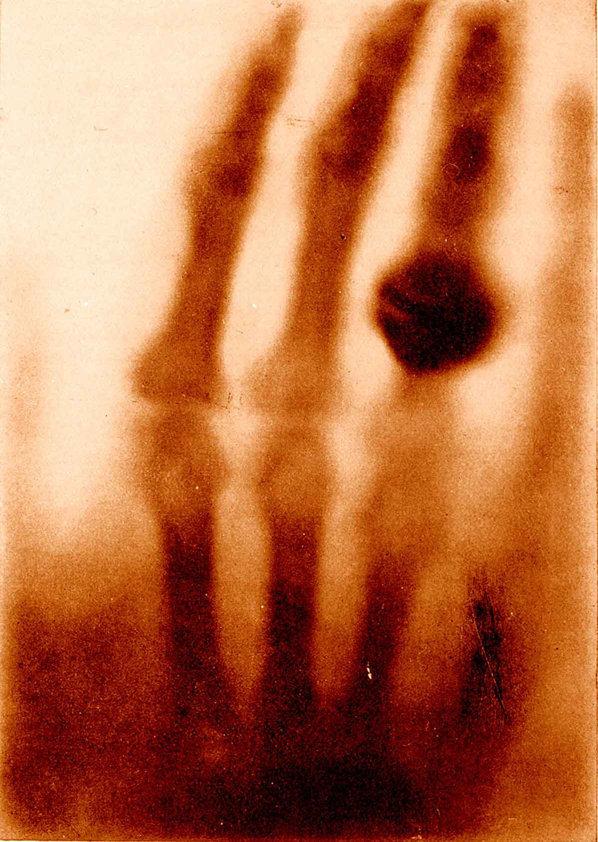 1895. Az első Röntgen felvétel. A képen Mrs. Röntgen keze látható..jpg
