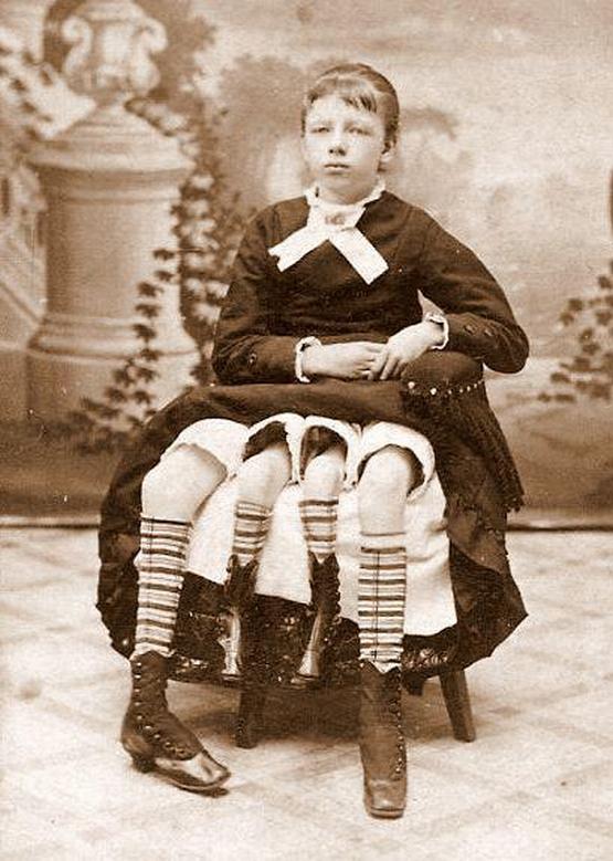 1888_korul_myrtle_corbin_who_was_born_with_two_sets_of_legs_two_pelvises_and_two_functional_sets_of_sexual_reproductive_organs.jpg