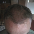 3. hónap - hajbeültetés után