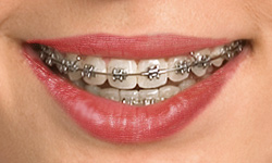 metal-braces.jpg