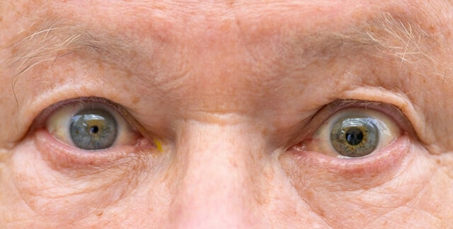 anisocoria-pupilla.jpg