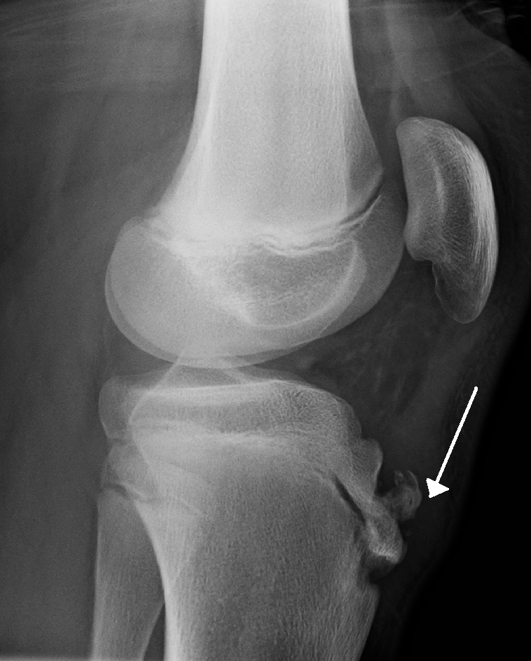 radiograph_of_human_knee_with_osgood_schlatter_disease.png