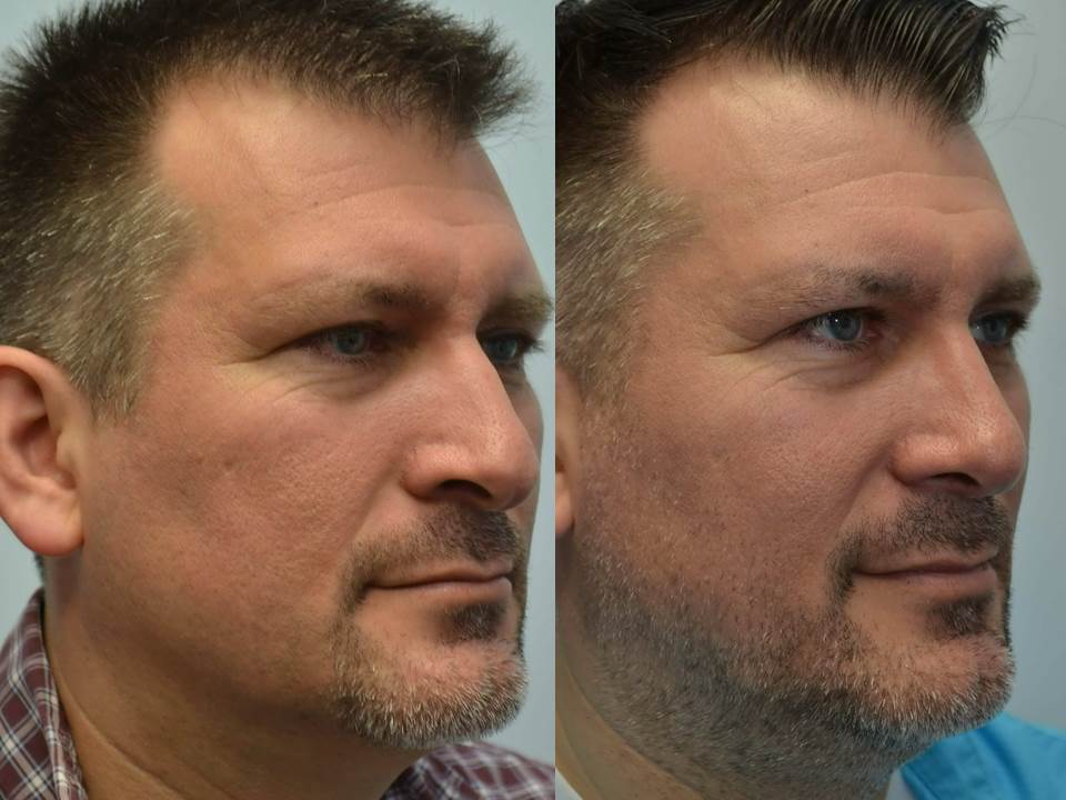 rhinoplasty-before-and-after-3c.jpg