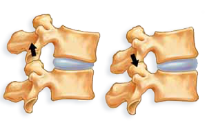 gerinc-csogolya-porckorong-egyoldalu-terheles-nyomas-serv-trans.png