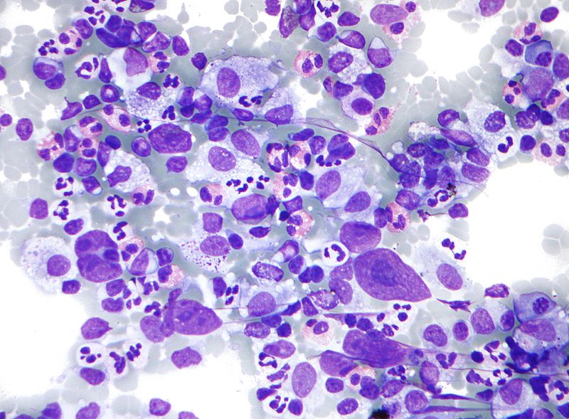 800px-hodgkin_lymphoma_cytology_large.jpg