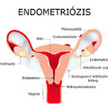 A fájdalom alakot ölt: Endometriózis