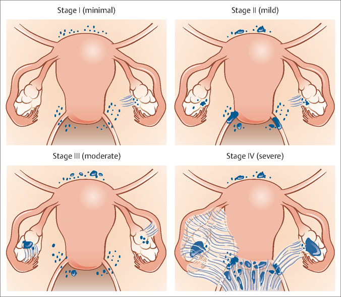 4-stages-of-endometriosis.jpg