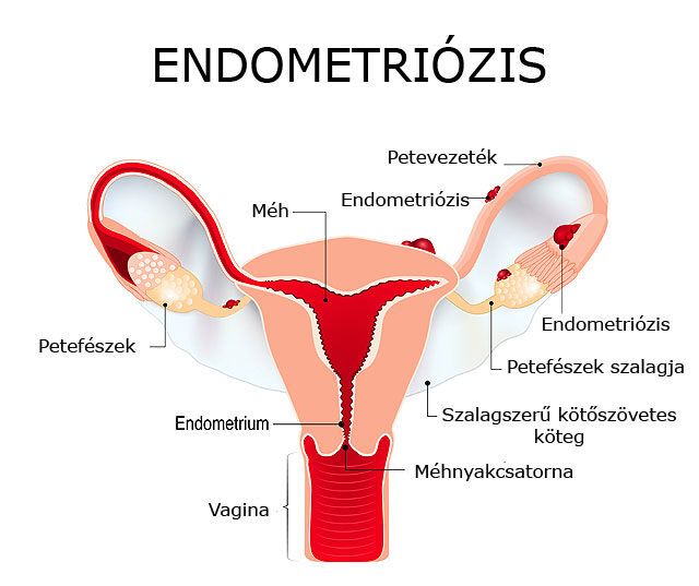 endometriozis.jpg