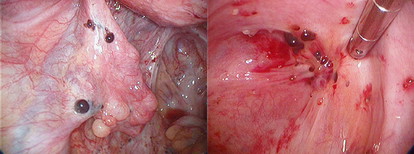 endometriozise.jpg
