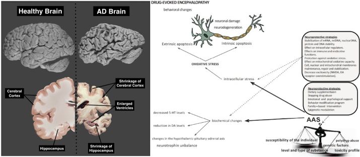 cerebralatrophy.jpg