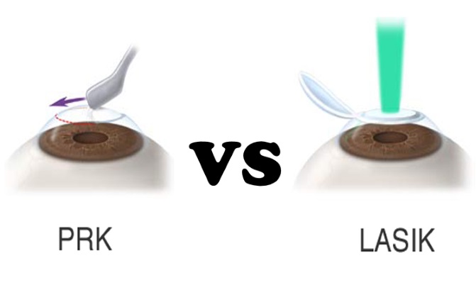 difference-between-lasik-and-prk.jpg
