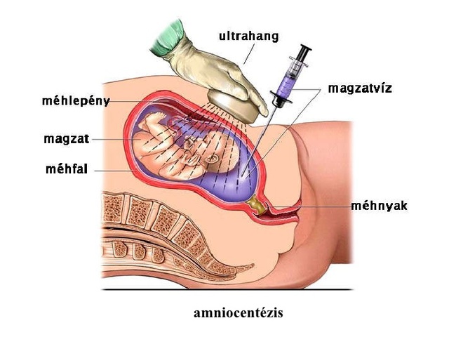 52. Amniocentézisen túl, eredményen innen