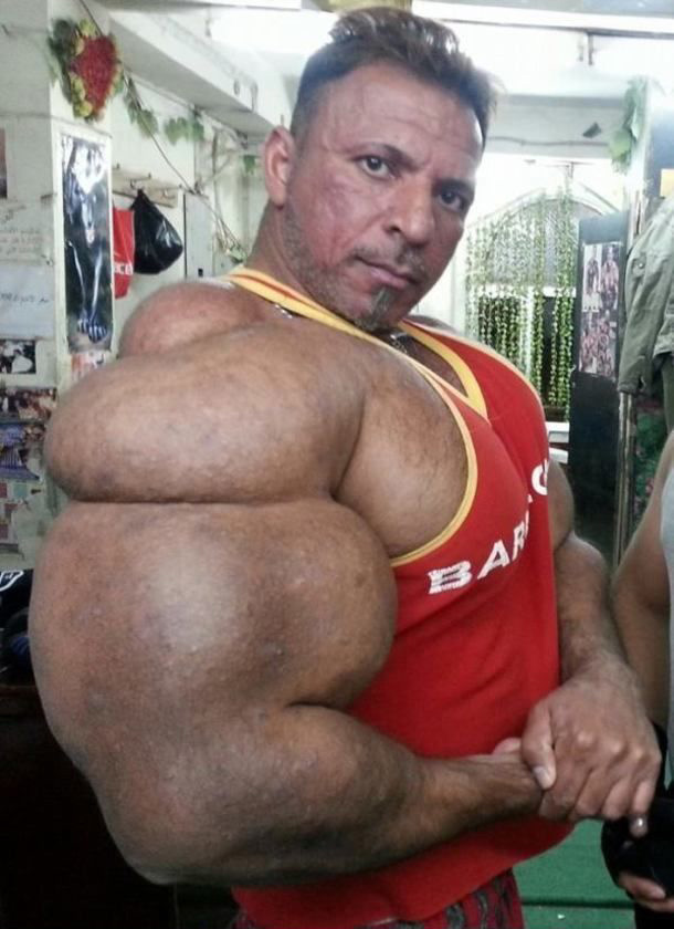 victims-of-synthol-how-bodybuilders-are-injecting-fat-into-their-arms-58186.jpg
