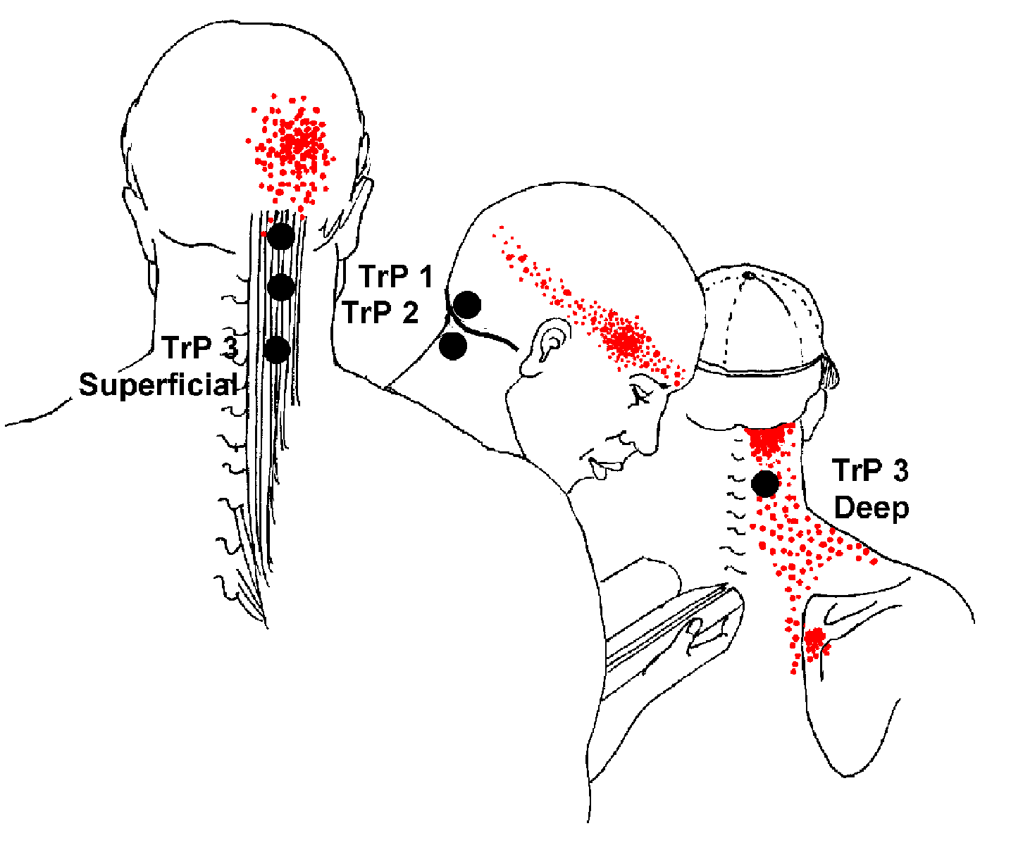 semispinalis_capitis_trigger_points.png
