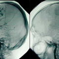 Az agyi leépülés augusztusi és szeptemberi tünetei