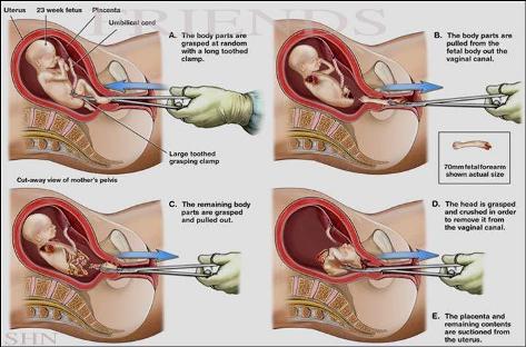 Second-Trimester-Abortion.jpg