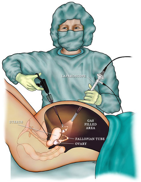 laparoscopy.jpg