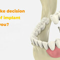 How dental implants help you?  How Dental Implants Can Transform Your Smile and Quality of Life